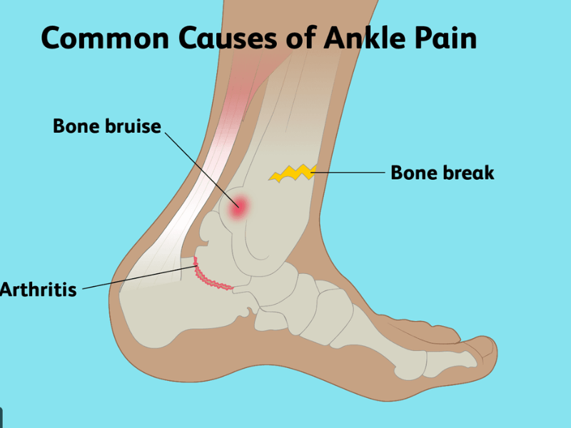 পায়ের গোড়ালি ব্যথার কারণ 
