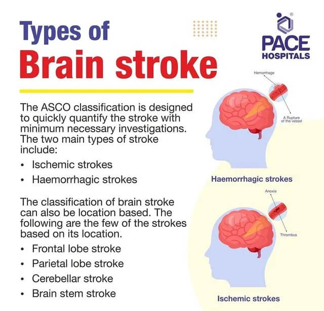 ব্রেইন স্ট্রোকের প্রকারভেদ